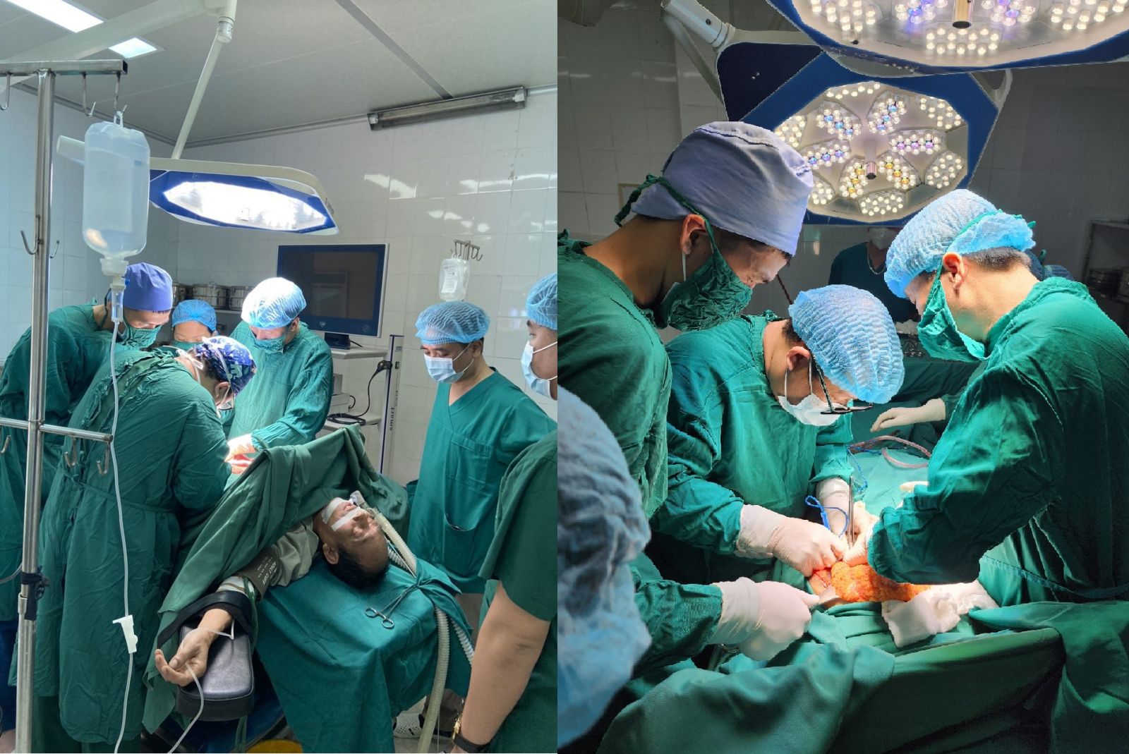   Bệnh viện Đa khoa huyện Kiến Xương phẫu thuật thành công cắt khối u đại tràng đã vỡ