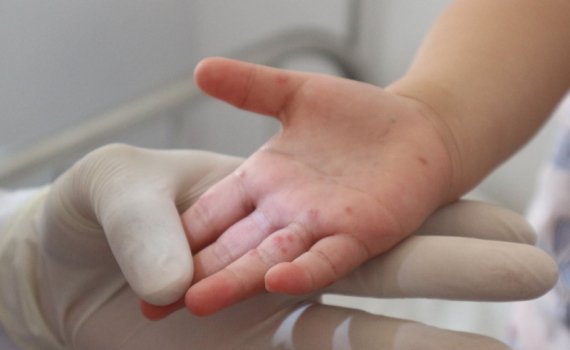   Chủ động phòng bệnh tay chân miệng